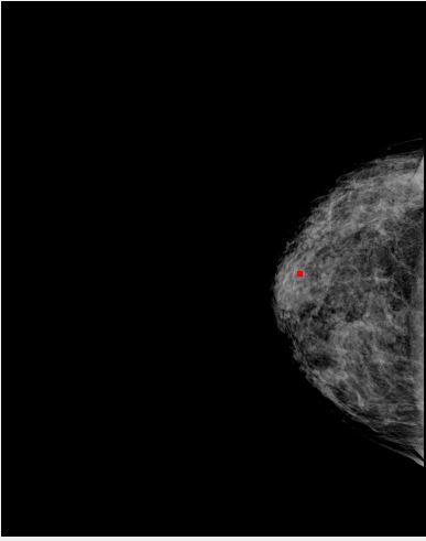 Raw Mammogram